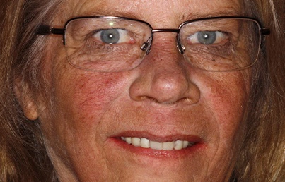 Smile gallary image - After